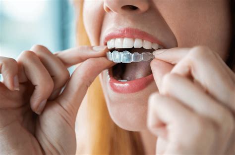 Magical teeth aligner for an instant smile makeover